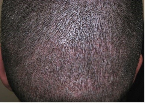 نصائح العناية بالشعر بعد اجراء عملية زراعة الشعر 4