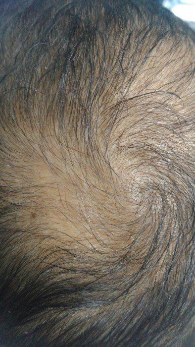 Dr. Yetkin Bayer | صعوبات زراعة الشعر في قمة الرأس