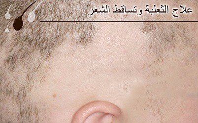 علاج الثعلبة: هل تصلح زراعة الشعر في حالات الثعلبة؟ 1