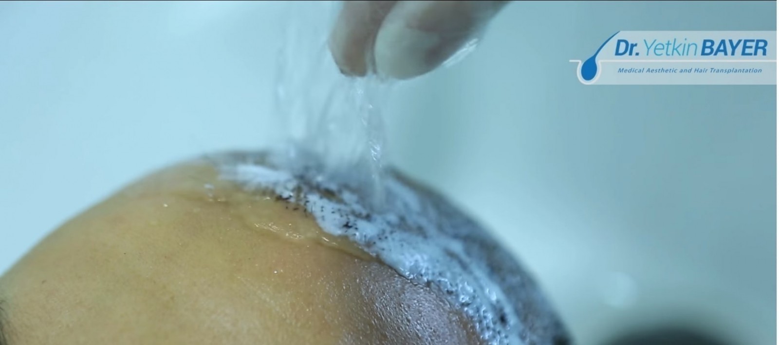 غسل الشعر بعد عملية زراعة الشعر