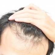 كيف تتم عملية زراعة الشعر بالتفصيل؟