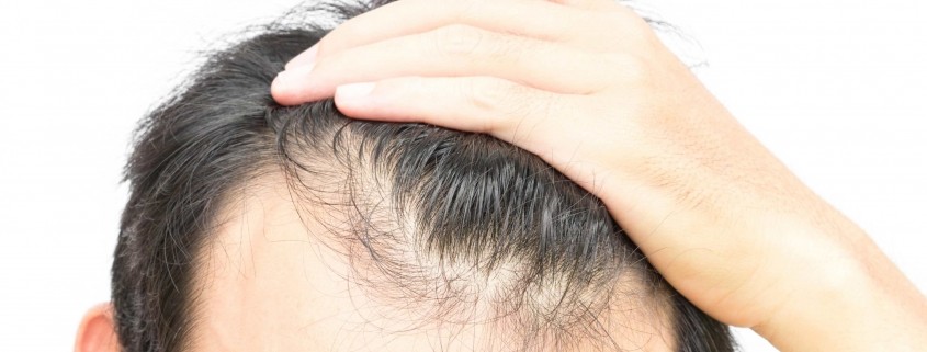 كيف تتم عملية زراعة الشعر بالتفصيل؟