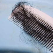 Saç Dökülmesi Nedir, Nedenleri Nelerdir ? 4