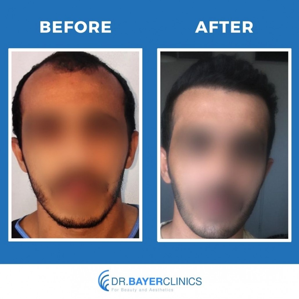 Hair Transplant Results in Turkey, Before & After 24