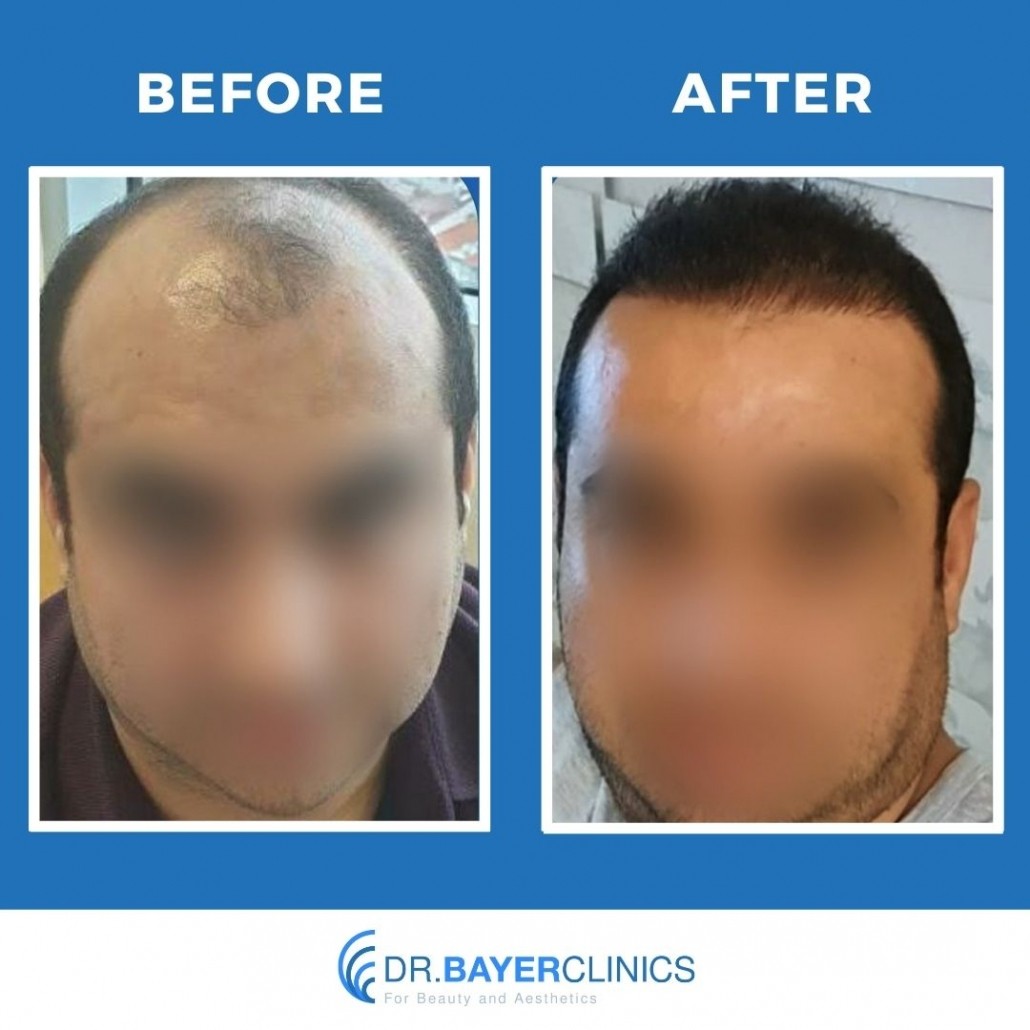 Hair Transplant Results in Turkey, Before & After 23
