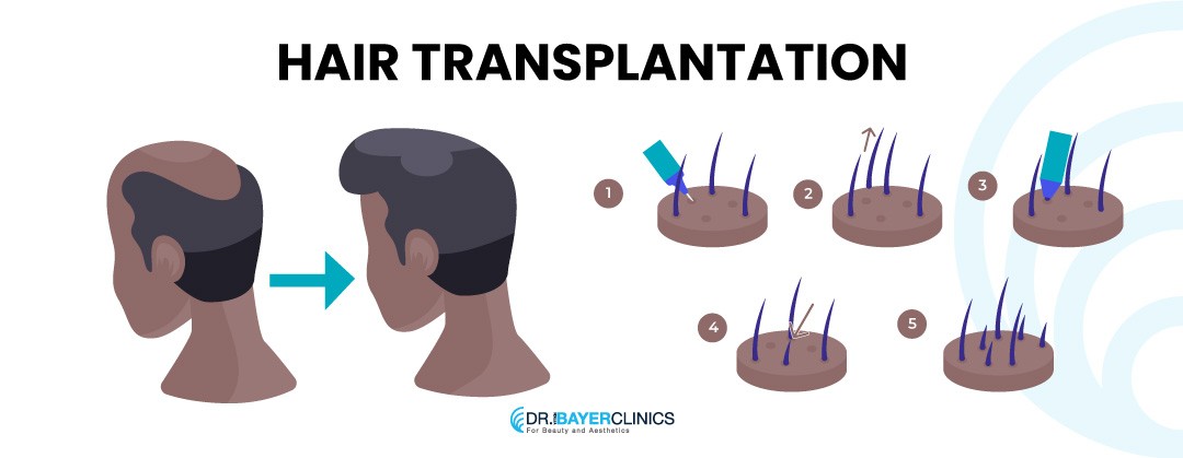 afro hair transplant procedure