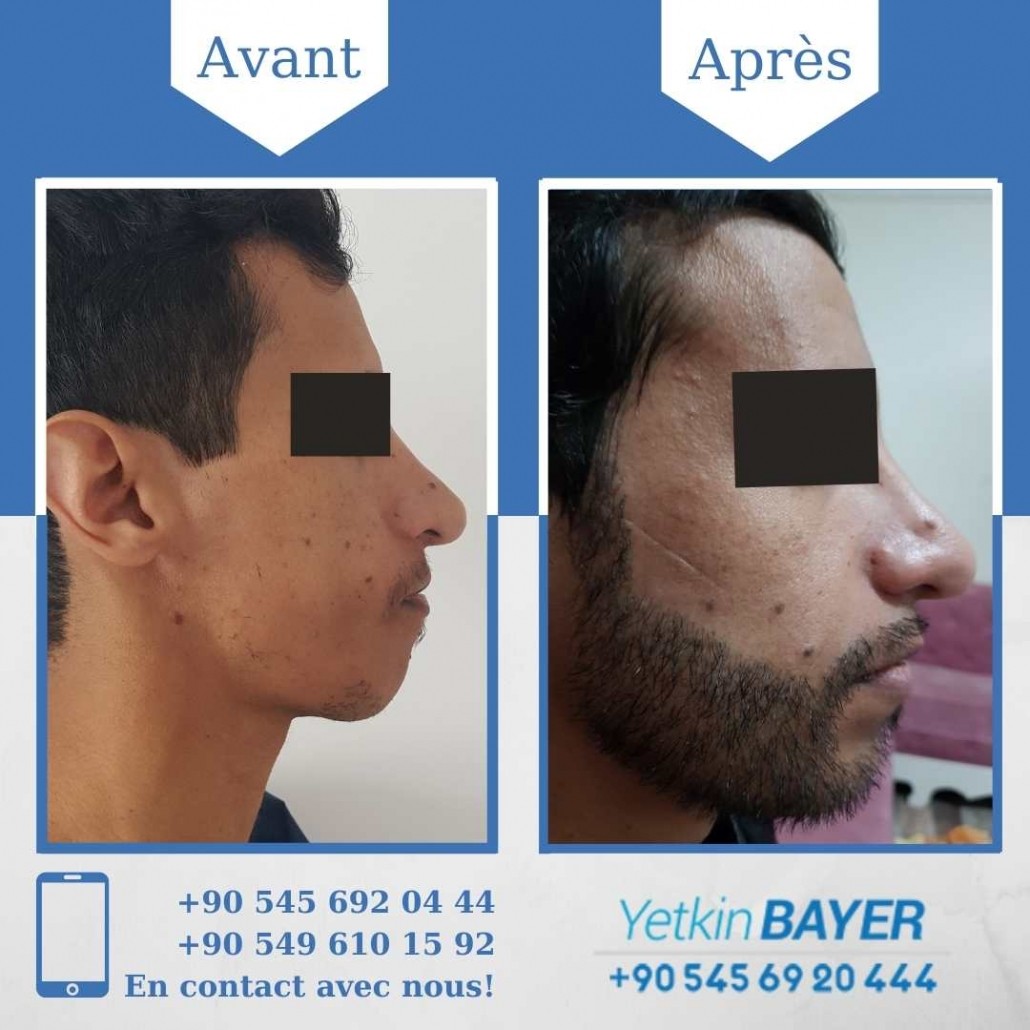 Résultats avant/après greffe de cheveux en Turquie 22