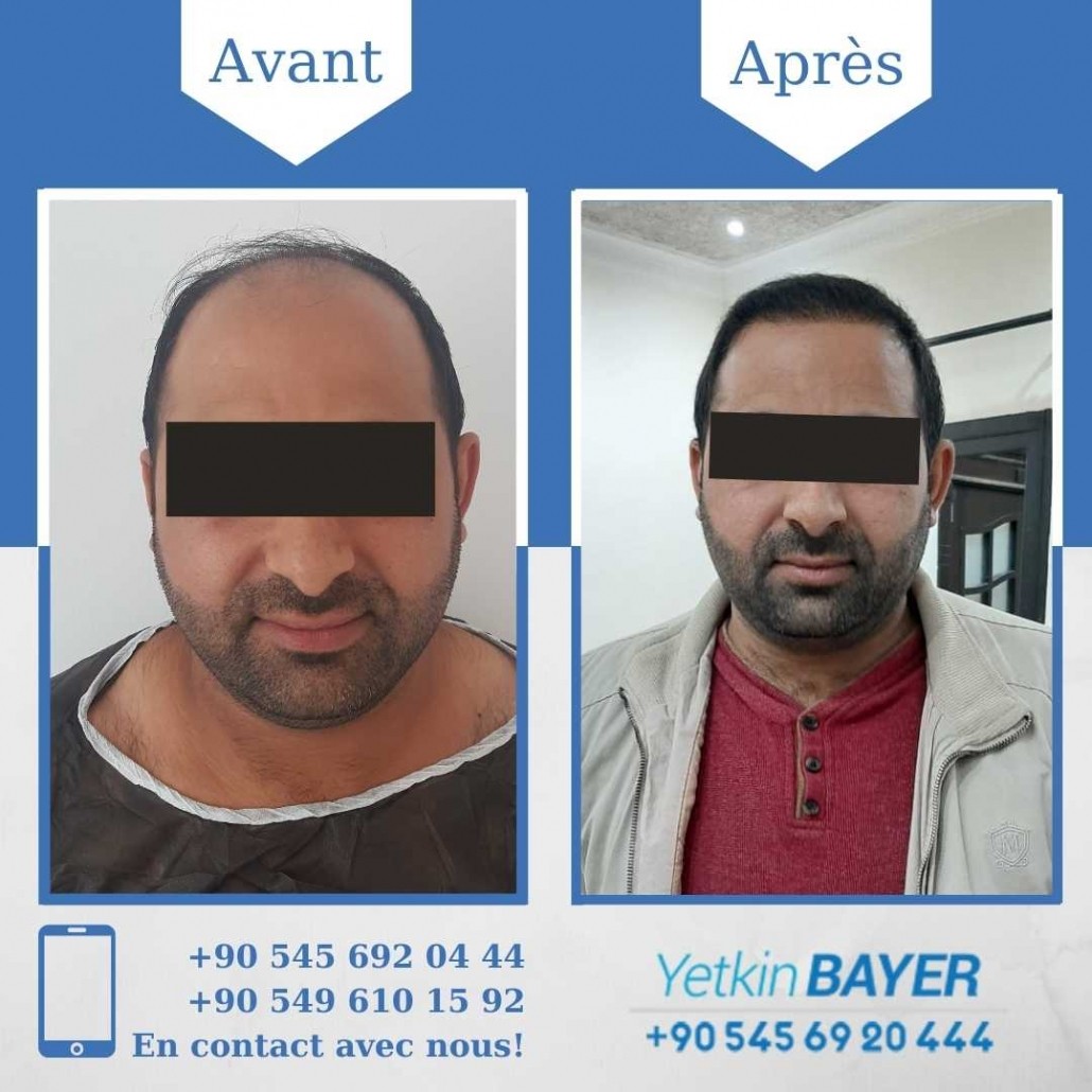 Résultats avant/après greffe de cheveux en Turquie 21