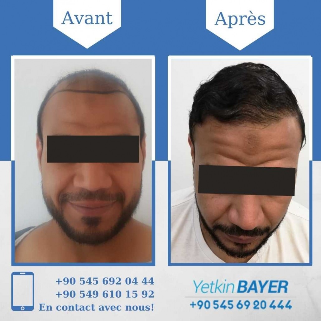 Résultats avant/après greffe de cheveux en Turquie 20