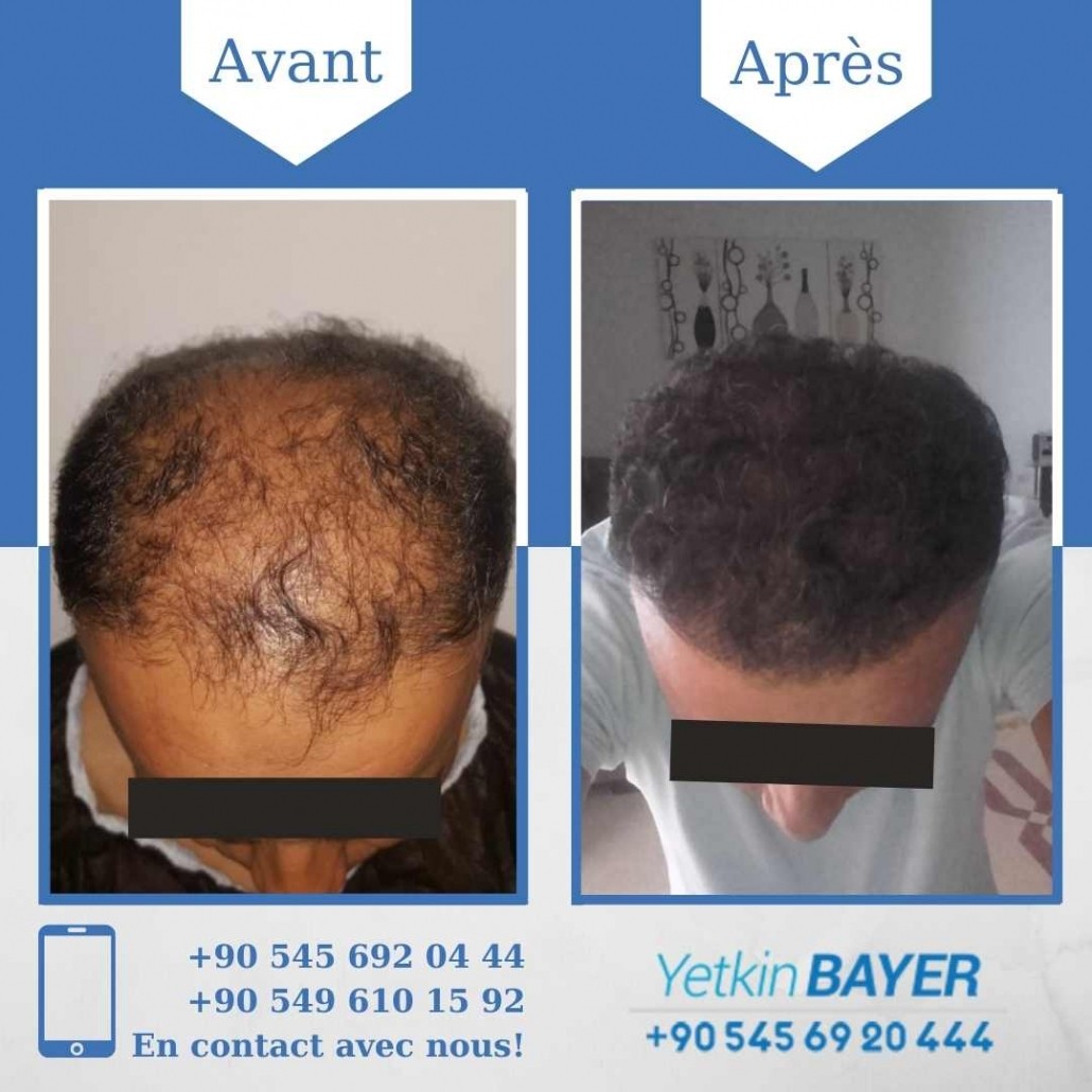 Résultats avant/après greffe de cheveux en Turquie 19