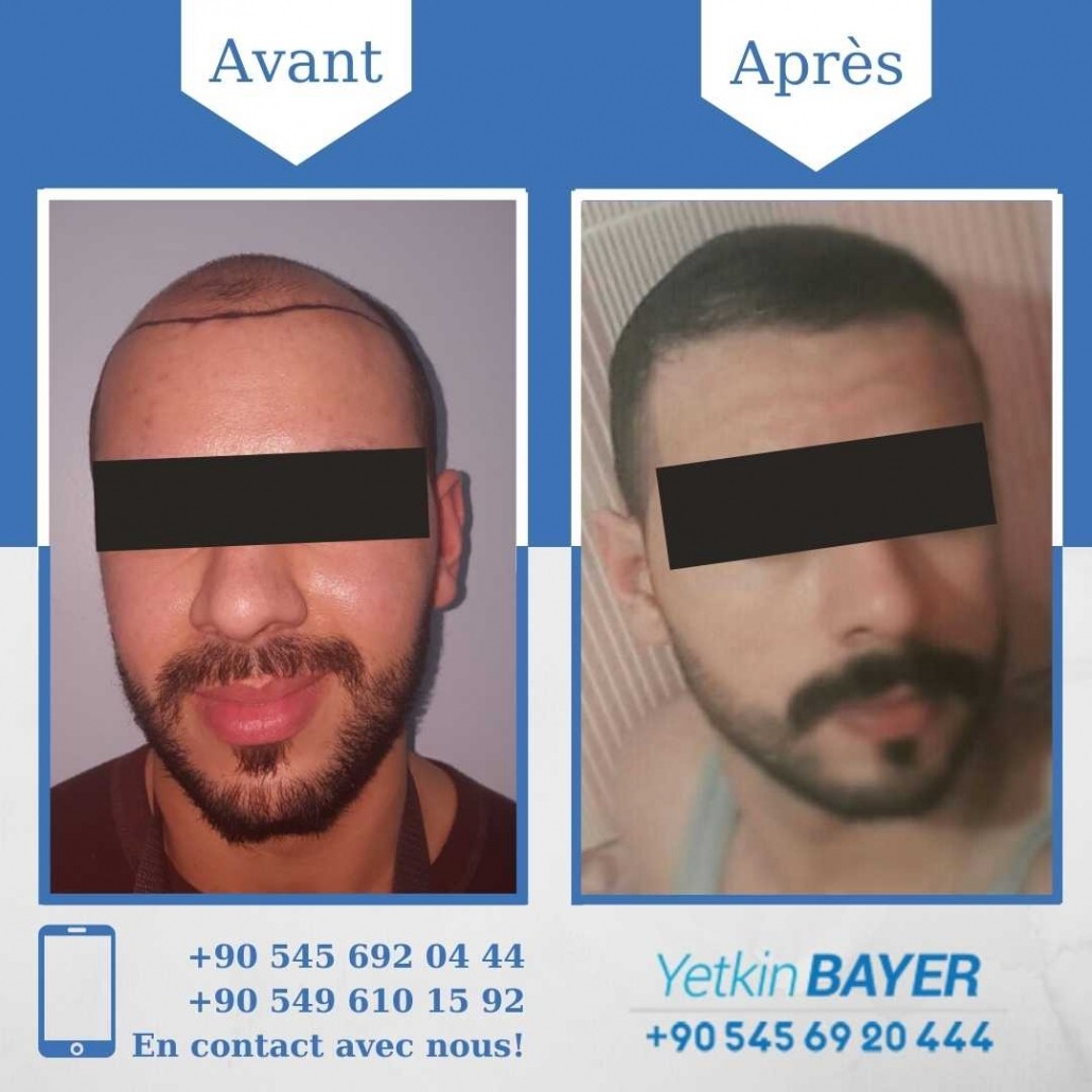 Résultats avant/après greffe de cheveux en Turquie 17