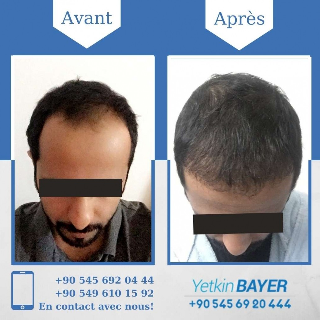 Résultats avant/après greffe de cheveux en Turquie 16