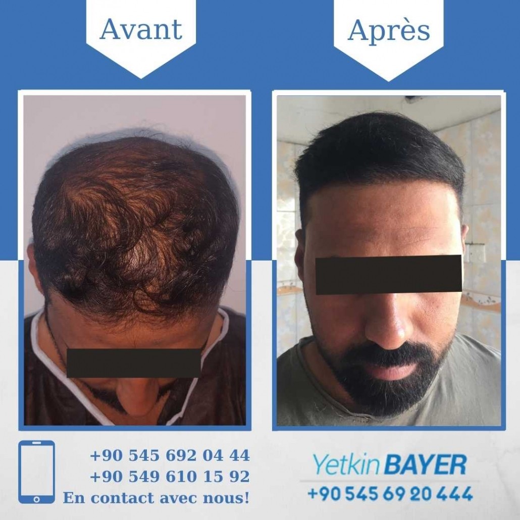 Résultats avant/après greffe de cheveux en Turquie 13