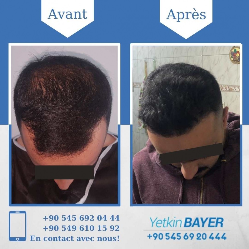 Résultats avant/après greffe de cheveux en Turquie 5