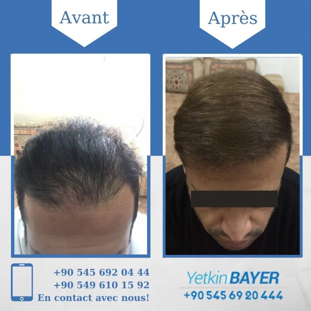 Résultats avant/après greffe de cheveux en Turquie 6