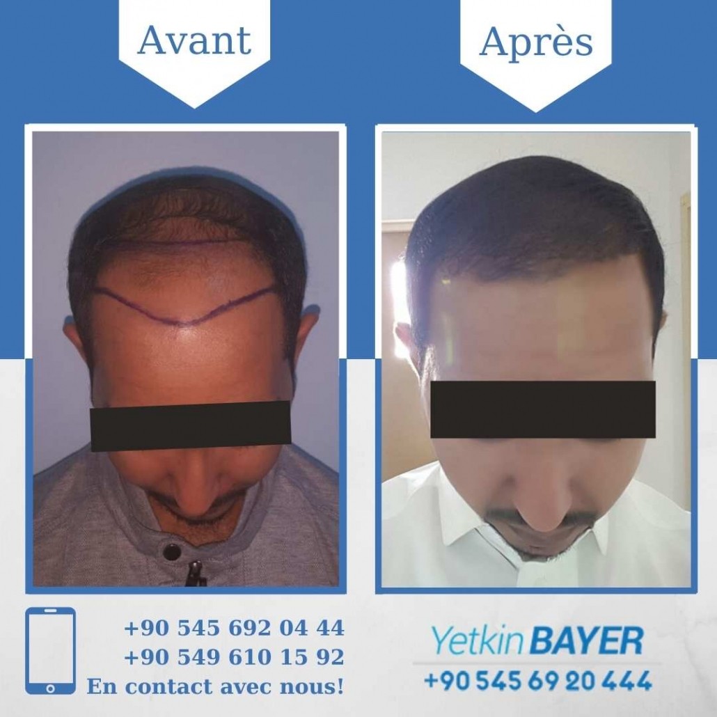 Résultats avant/après greffe de cheveux en Turquie 5