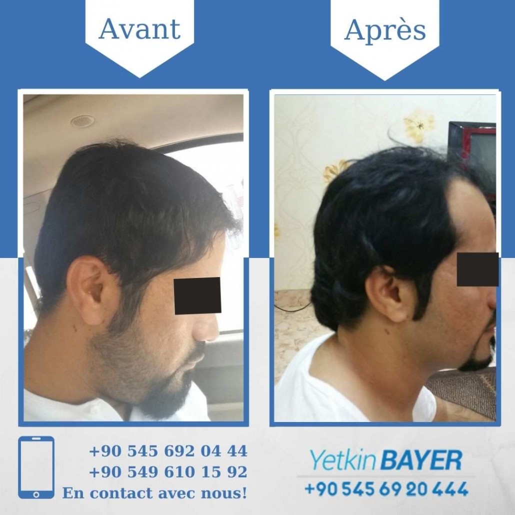 Résultats avant/après greffe de cheveux en Turquie 8