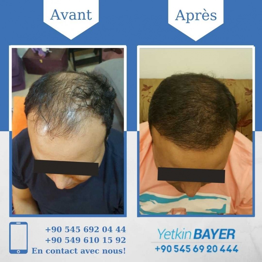 Résultats avant/après greffe de cheveux en Turquie 7