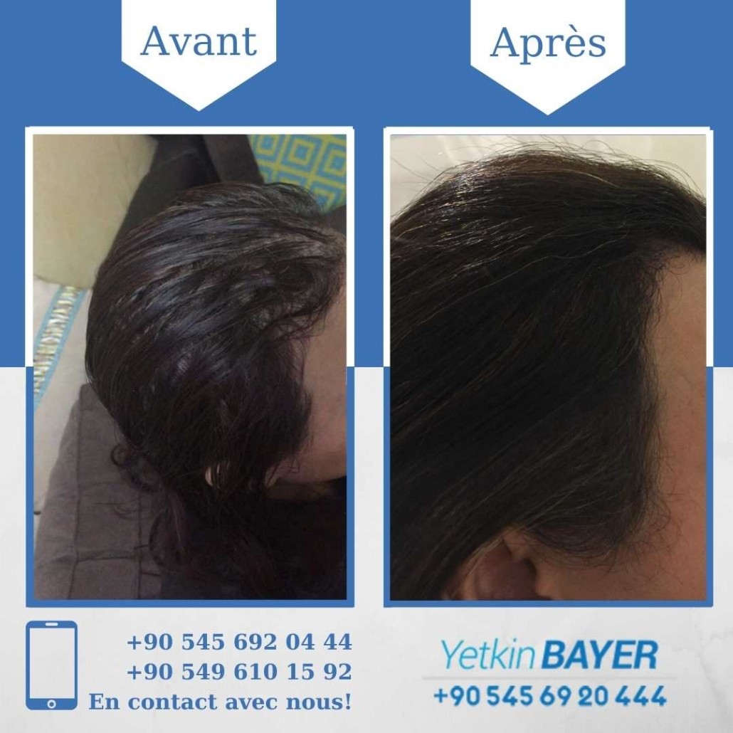 Résultats avant/après greffe de cheveux en Turquie 23