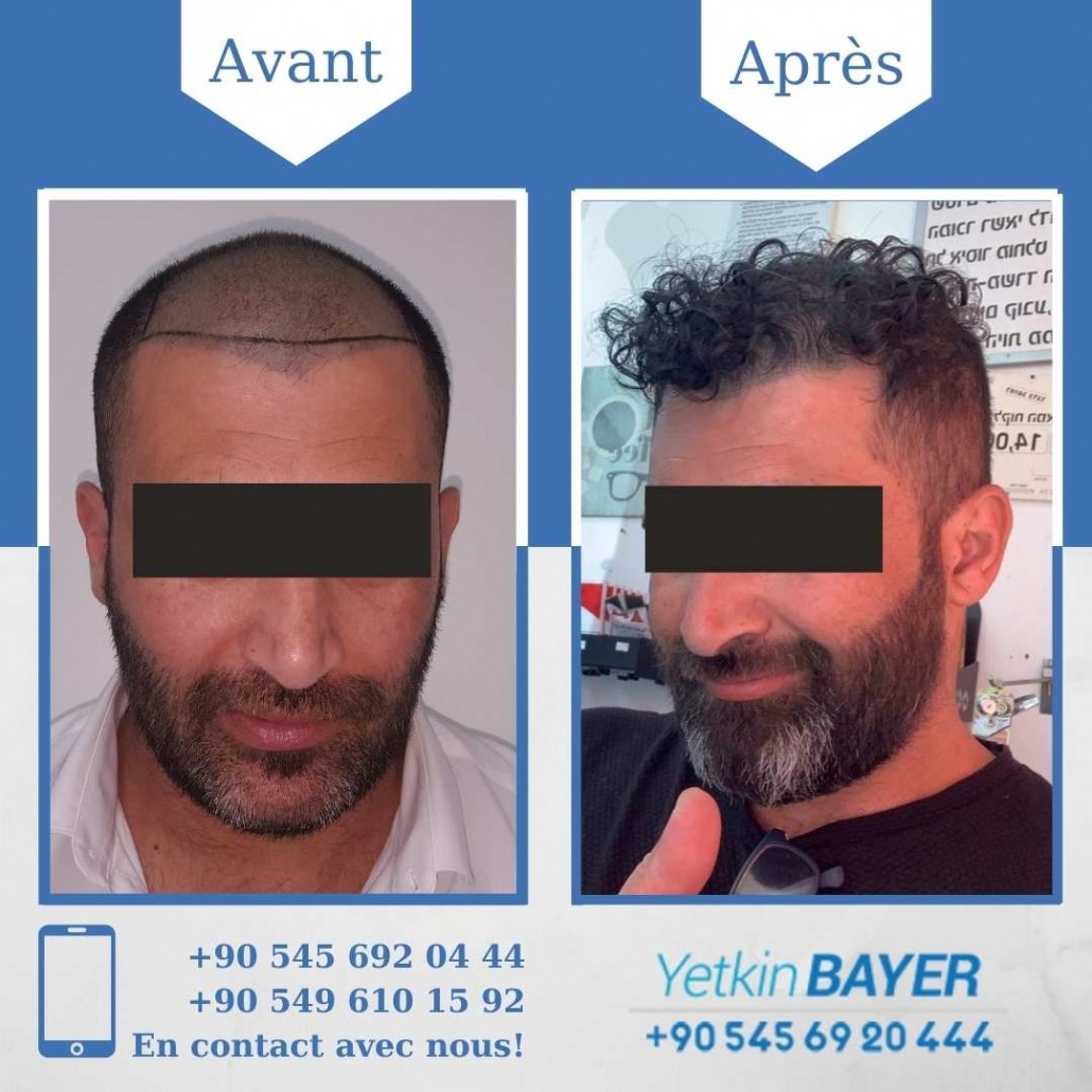 Résultats avant/après greffe de cheveux en Turquie 12