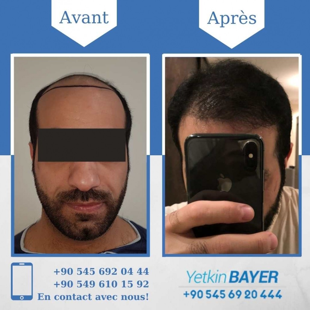 Résultats avant/après greffe de cheveux en Turquie 12