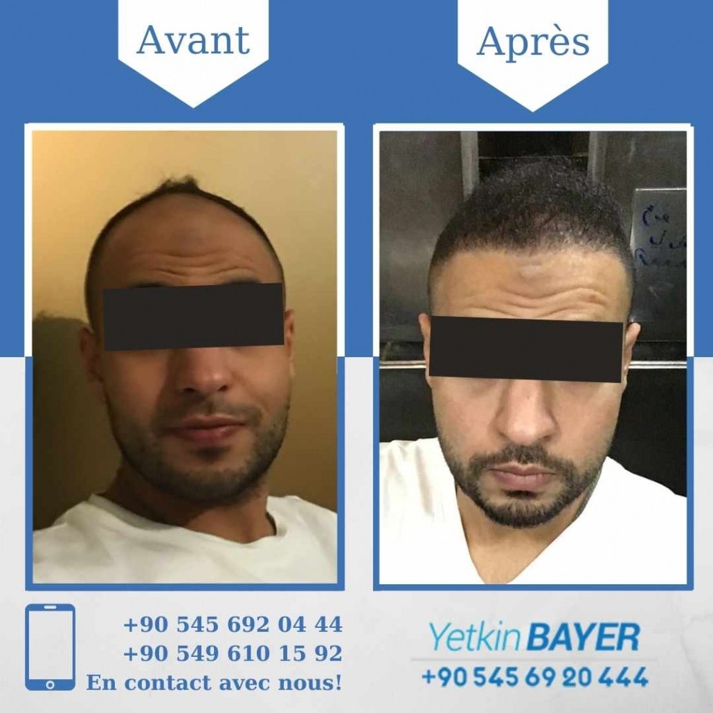 Résultats avant/après greffe de cheveux en Turquie 3