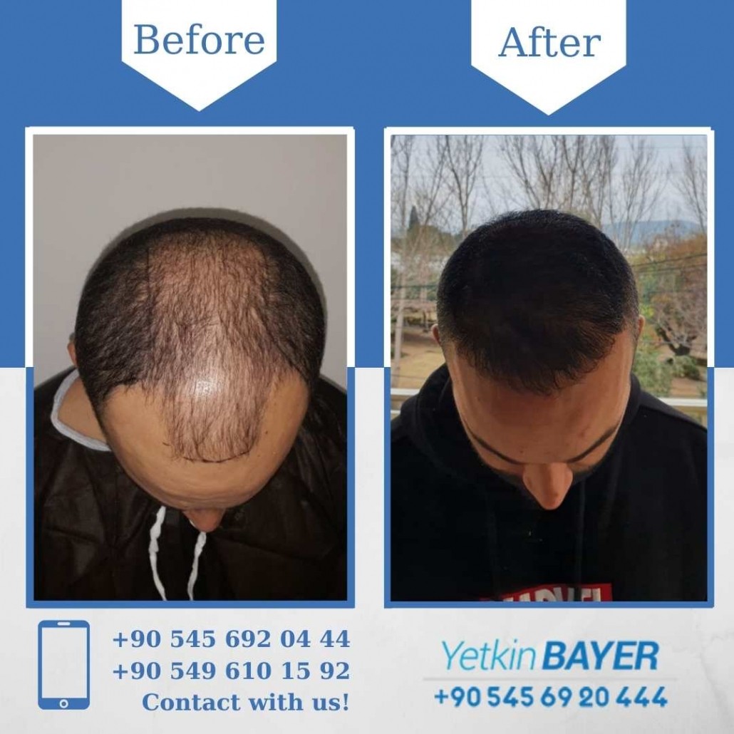 Hair Transplant Results in Turkey, Before & After 9