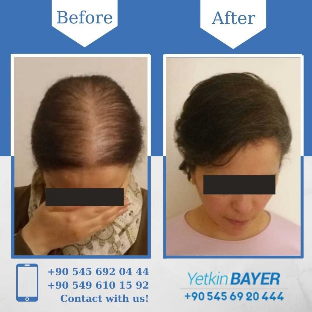 female hair transplant before and after