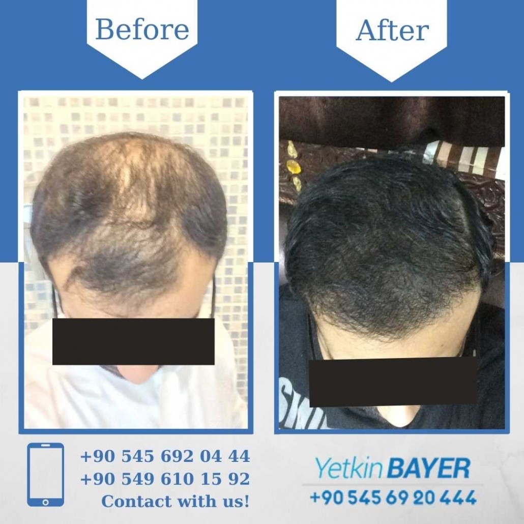Hair Transplant Results in Turkey, Before & After 17