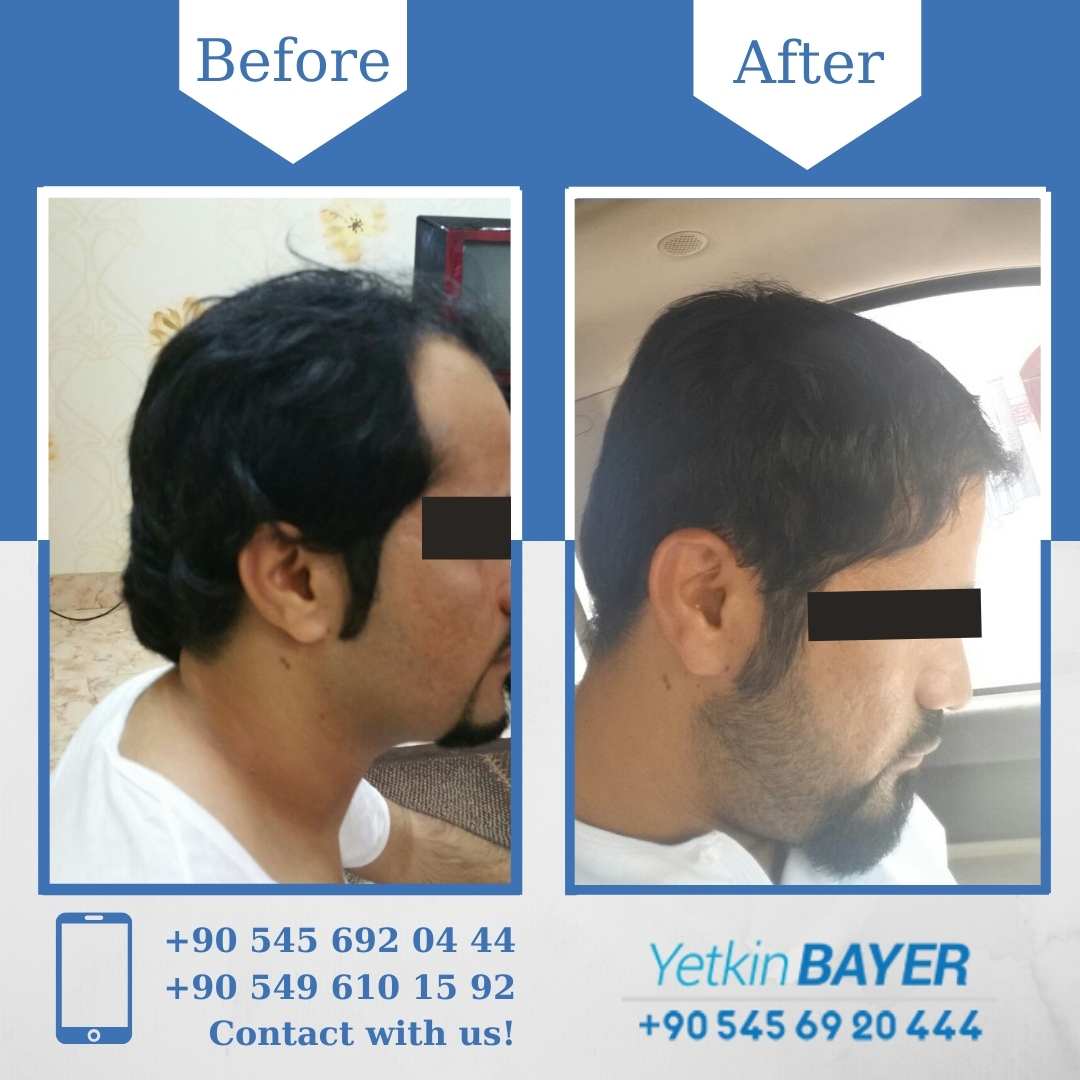Unshaven Hair Transplant in Turkey 14