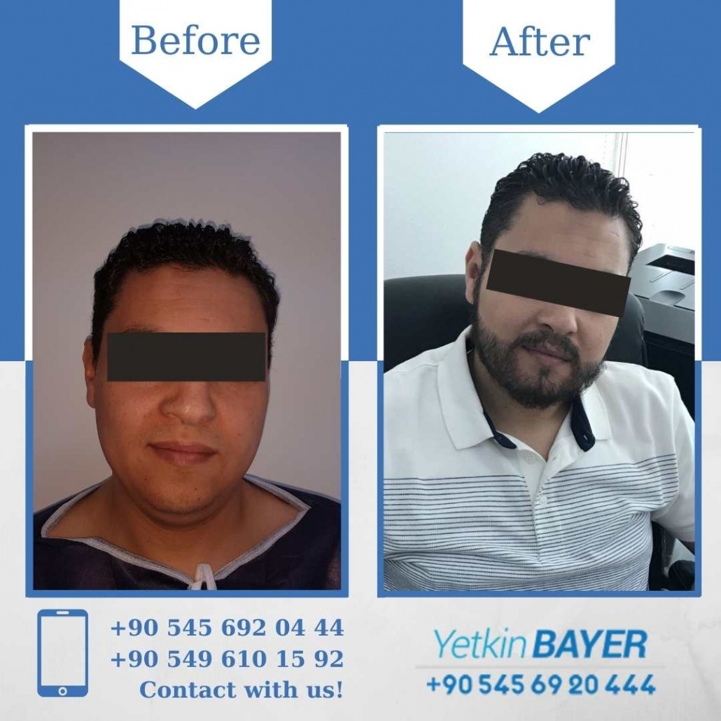 Hair Transplant Results in Turkey, Before & After 19