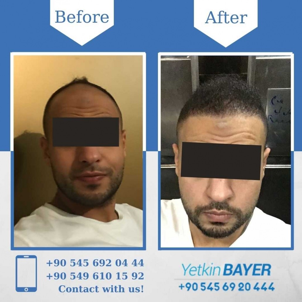 Hair Transplant Results in Turkey, Before & After 22