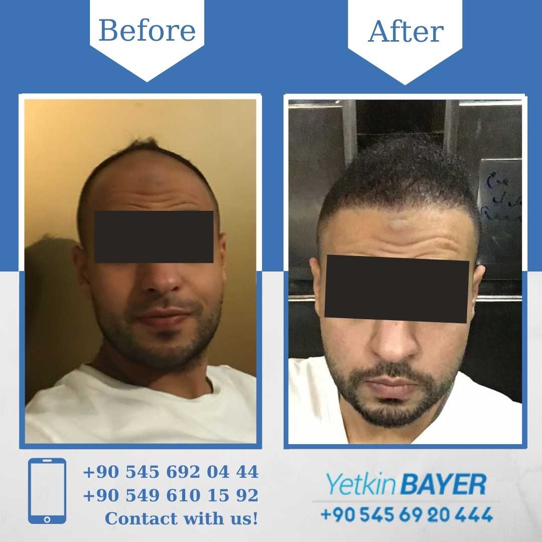 Unshaven Hair Transplant in Turkey 2