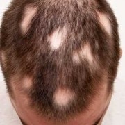 L’alopecia areata