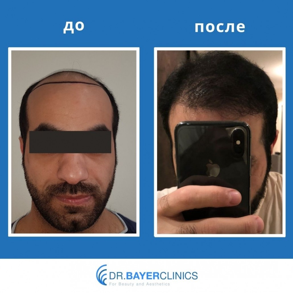 Пересадка волос: до и после 15