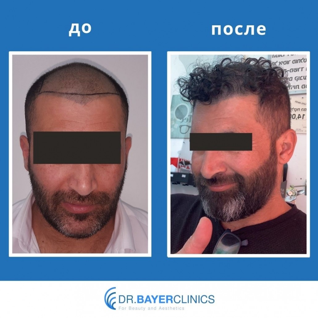 Пересадка волос: до и после 19