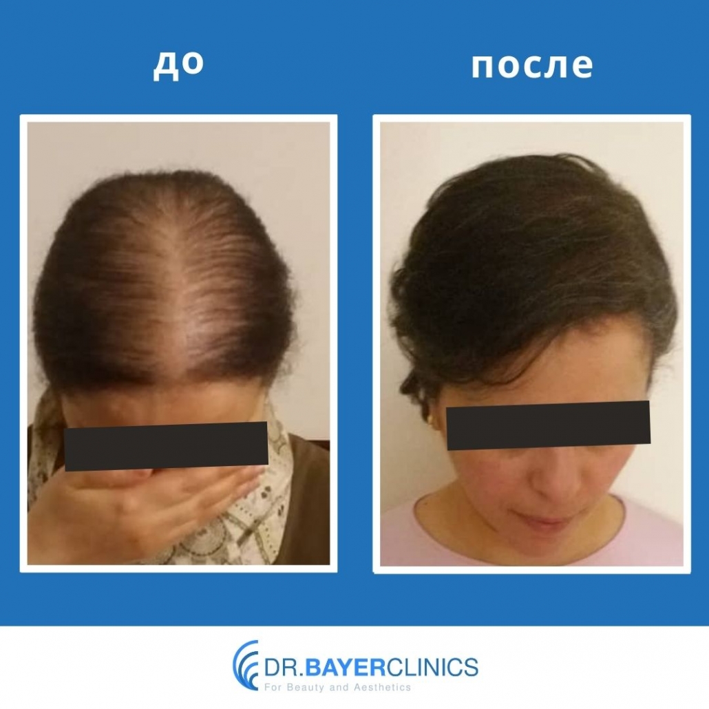 Пересадка волос: до и после 49