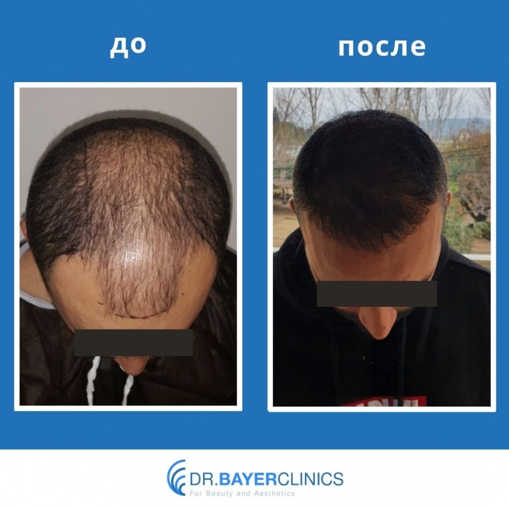 Пересадка волос: до и после 45