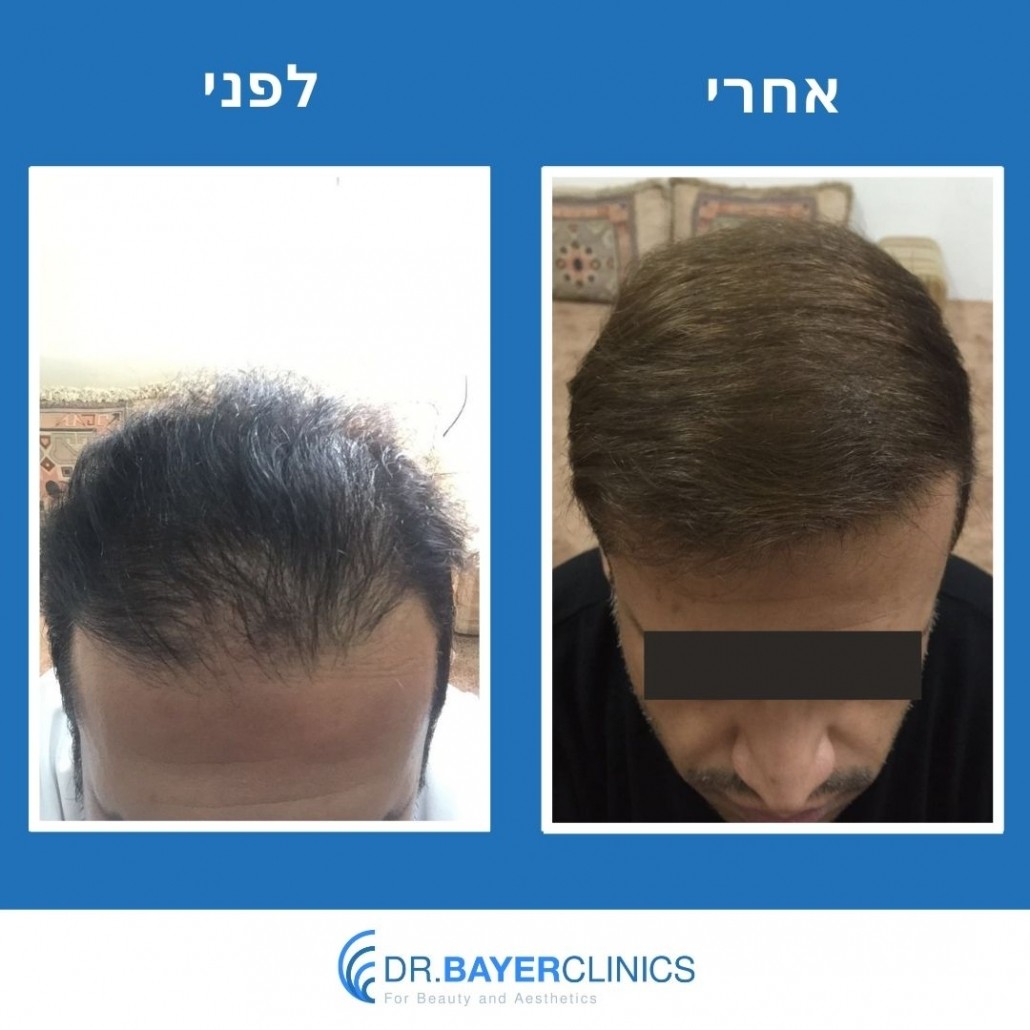 השתלת שיער בטורקיה לפני ואחרי 24