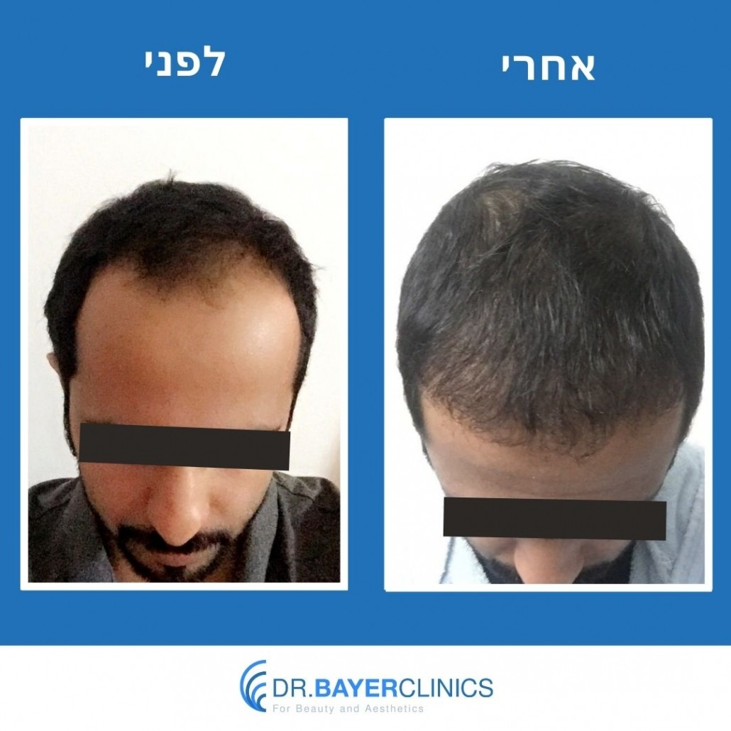 השתלת שיער בטורקיה לפני ואחרי 27