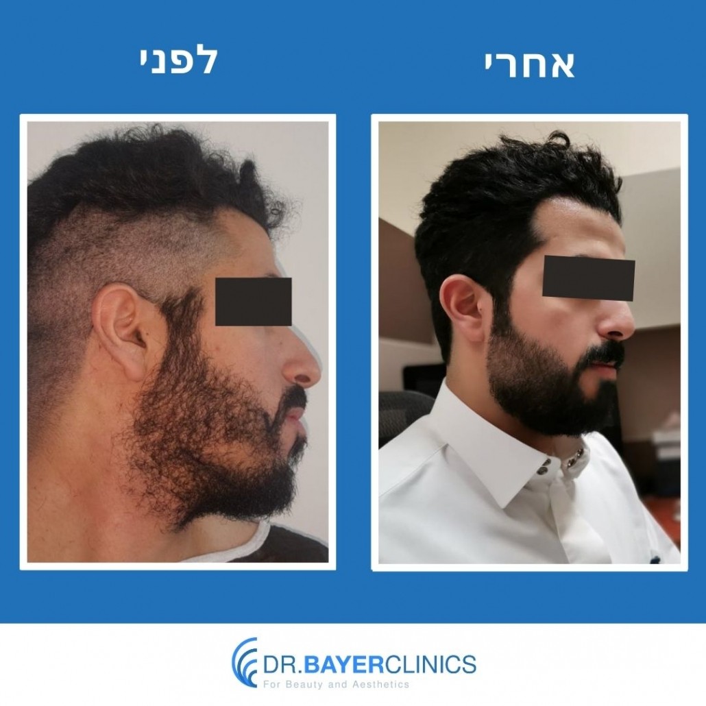 השתלת שיער בטורקיה לפני ואחרי 4