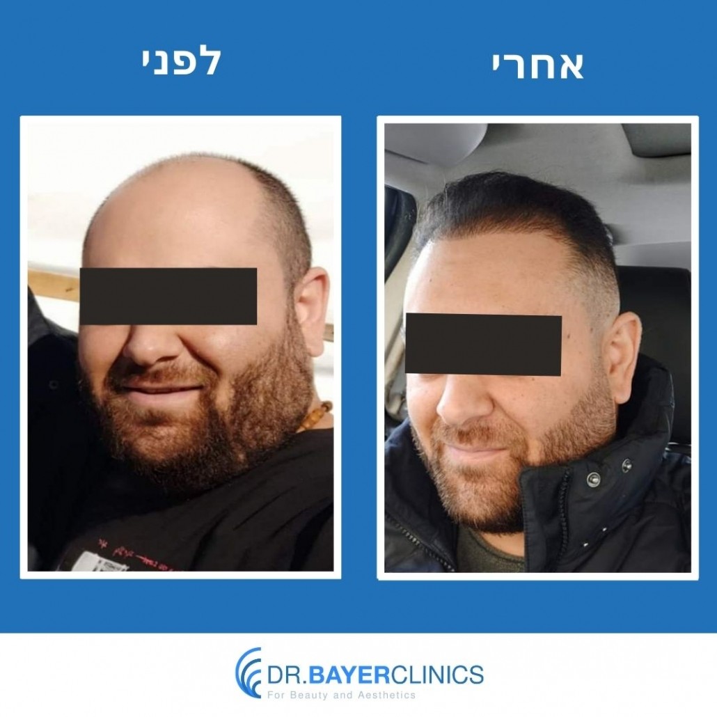 השתלת שיער בטורקיה לפני ואחרי 38