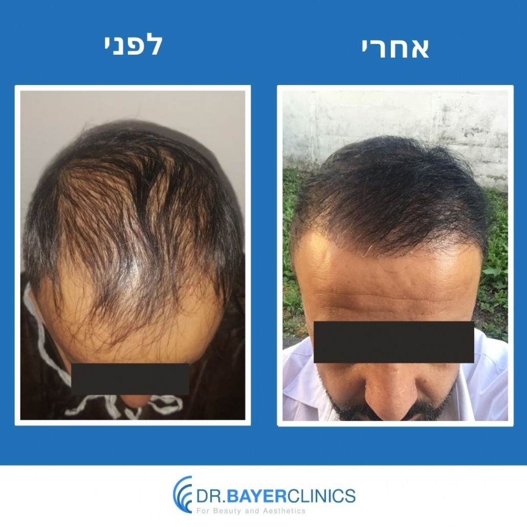 השתלת שיער בטורקיה לפני ואחרי 41