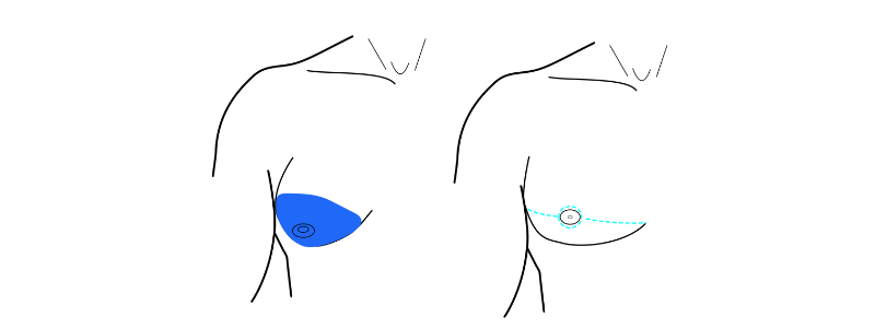 Gynecomastia Surgery ( Male Breast Reduction ) in Turkey 7