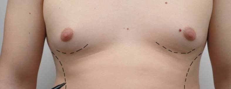 Gynecomastia Surgery in Turkey istanbul reviews and package prices