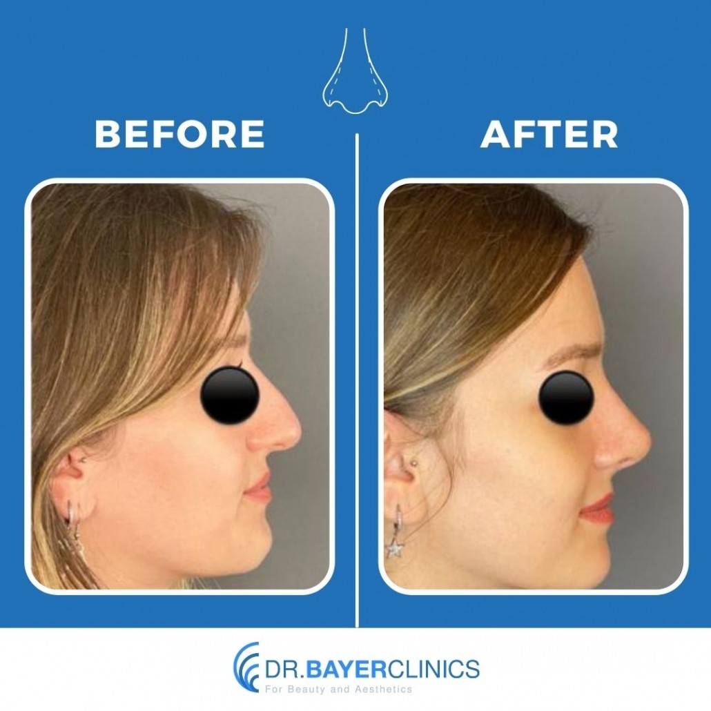 Nose Job Rhinoplasty Before and After Gallery 8