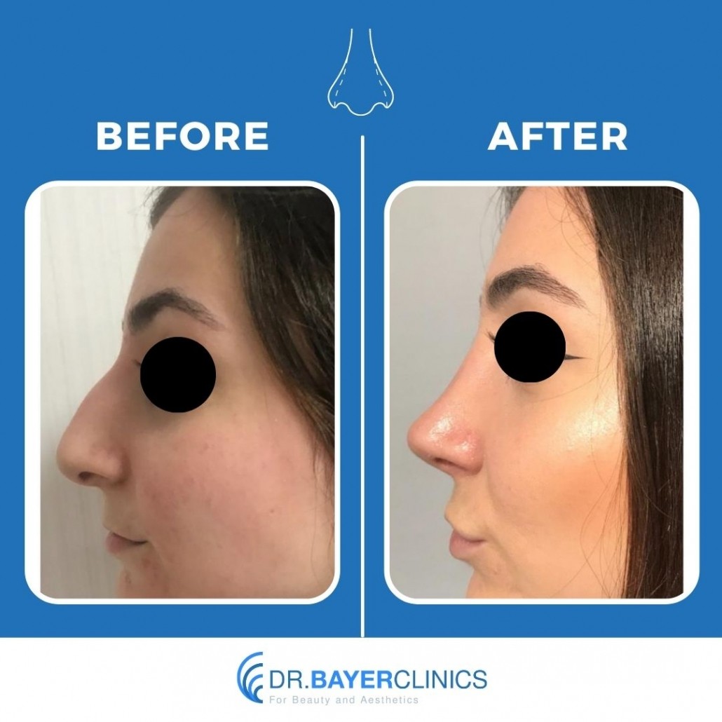 rhinoplasty before and after thick skin