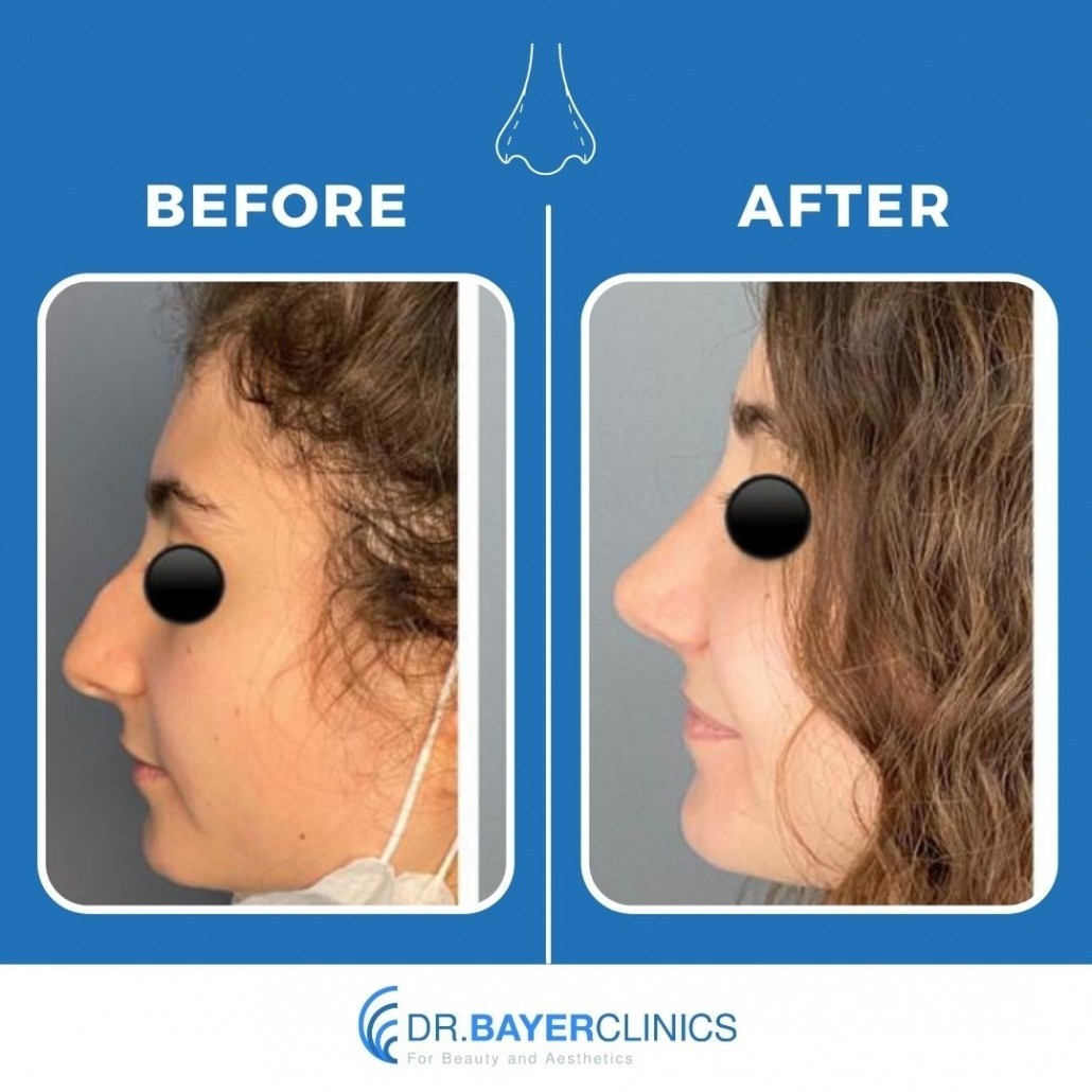 Nose Job Rhinoplasty Before and After Gallery 10