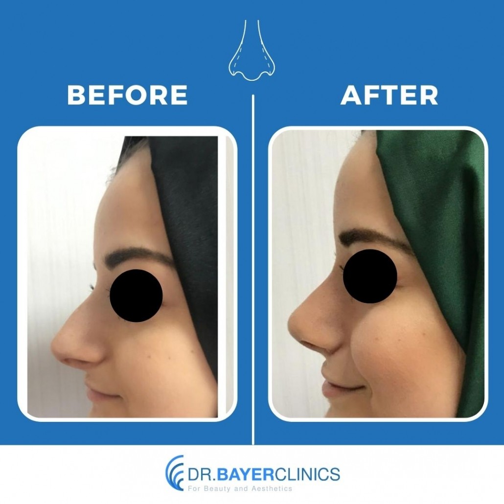 Nose Job Rhinoplasty Before and After Gallery 12