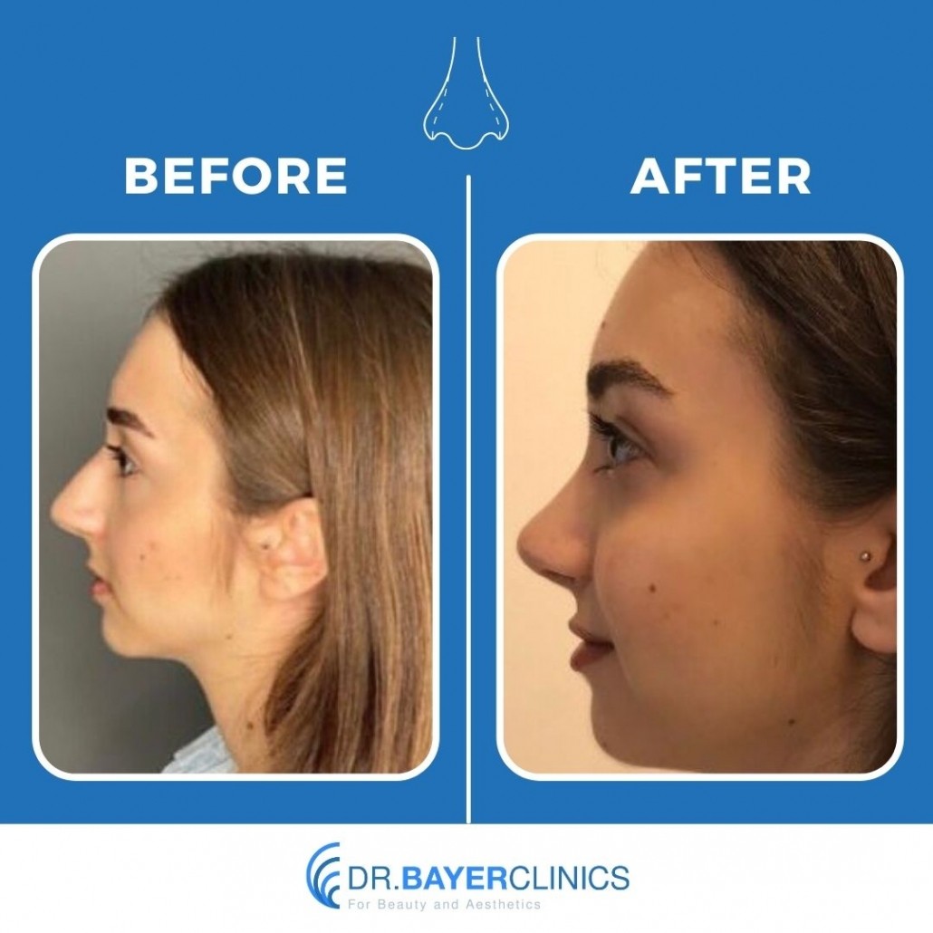 Nose Job Rhinoplasty Before and After Gallery 13